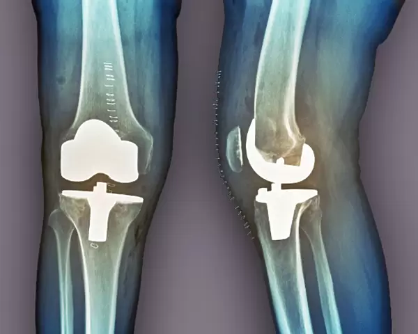 Total knee replacement, X-rays