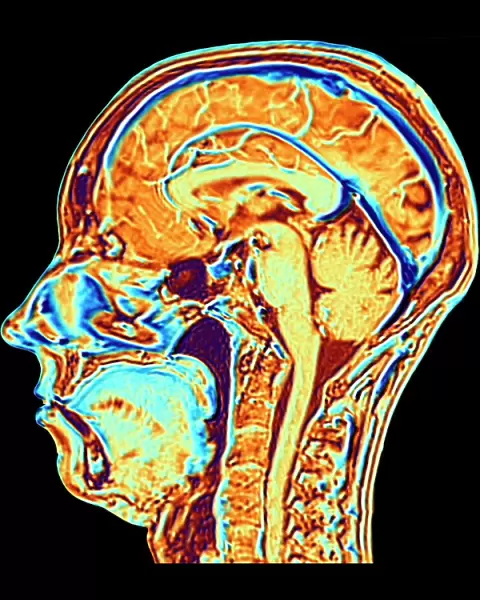 MRI scan of normal brain, illustration