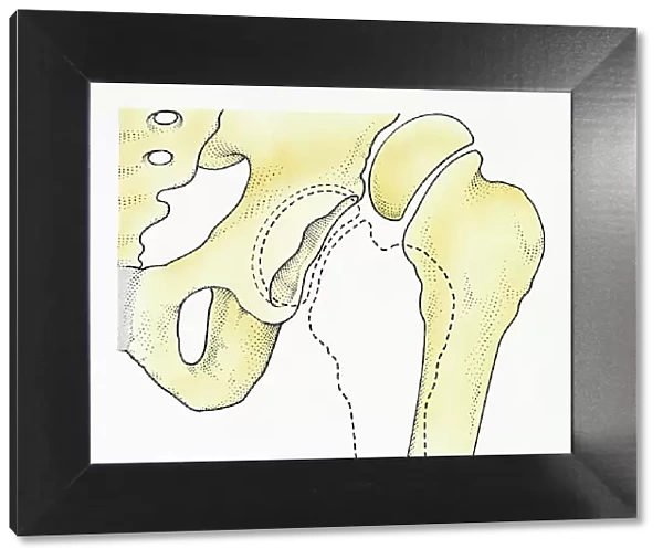 Digital illustration of dislocated hip