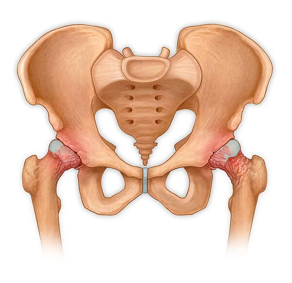 Anterior view of pelvis with hip bones showing arthritis and osteophytes on femoral heads