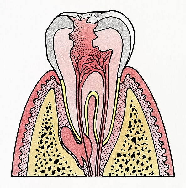 Cross section illustration showing tooth decay