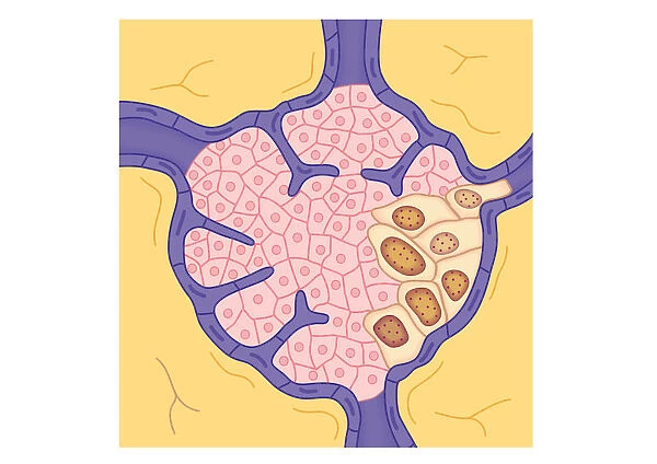 Digital illustration of tumour in lymph node