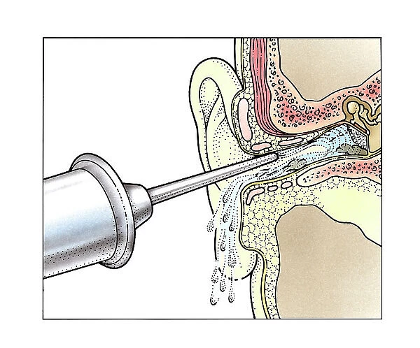 Injecting water into ear with syringe
