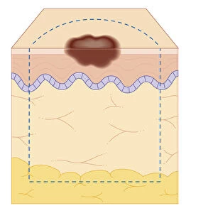 Cross section biomedical illustration of site of skin biopsy