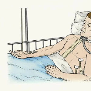 Illustration of male patient lying in bed connected to IV drip, ventilator attached to trachea, and tubes in chest after lung transplant surgery