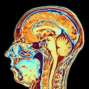 MRI scan of normal brain, illustration