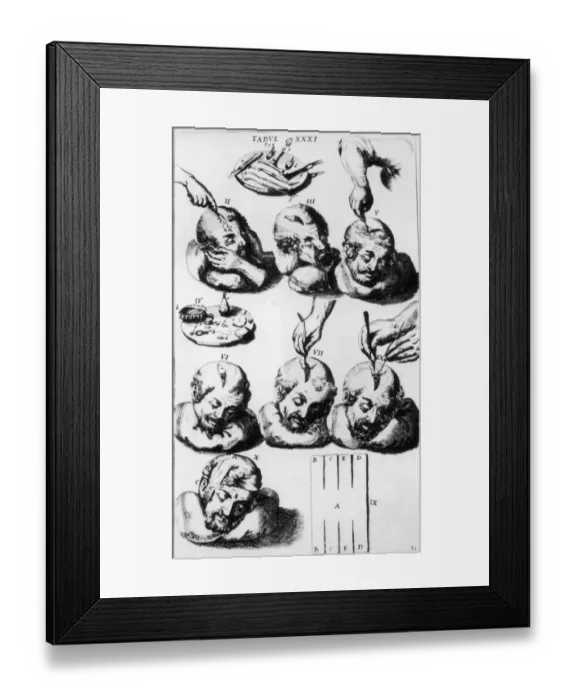 Framed Print : Trepanation Framed Print : Trepanation