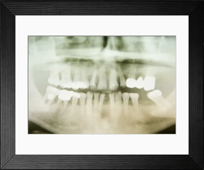 Framed Print : X-ray image of a human jaw with treated teeth, Germany, Europe Framed Print : X-ray image of a human jaw with treated teeth, Germany, Europe