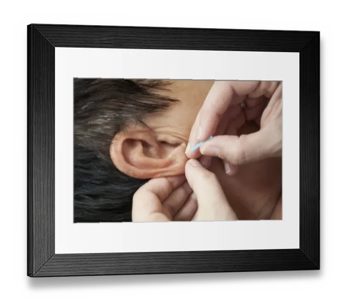 Framed Print : Acupuncture treatment Framed Print : Acupuncture treatment