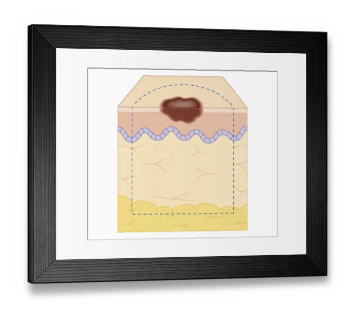 Framed Print : Cross section biomedical illustration of site of skin biopsy