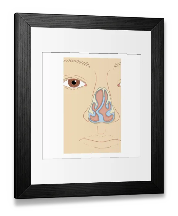 Framed Print : Cross section biomedical illustration of nasal septum deviation, close-up