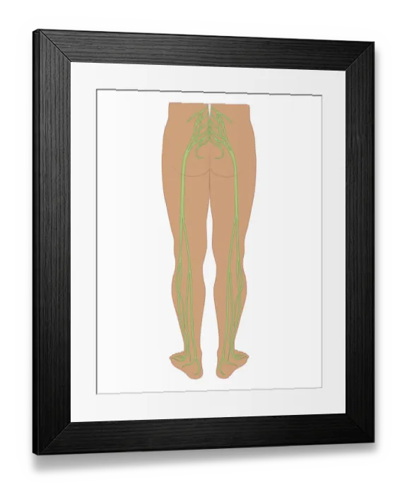 Framed Print : Cross section biomedical illustration of sciatic nerves beginning at the lower back, through buttocks down to lower limbs