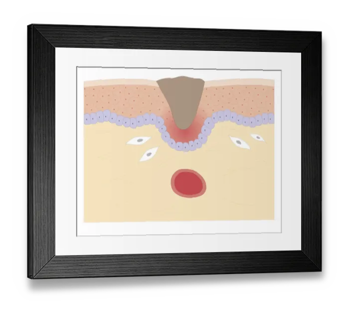 Framed Print : Cross section biomedical illustration of skin repair with fibroblast forming plug within Thrombus (blood clot) which contracts and plug shrinks and new skin tissue forms underneath