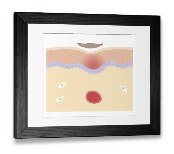 Framed Print : Cross section biomedical illustration of skin repair with fibrous plug hardening to become scab which falls off when new skin growth is complete