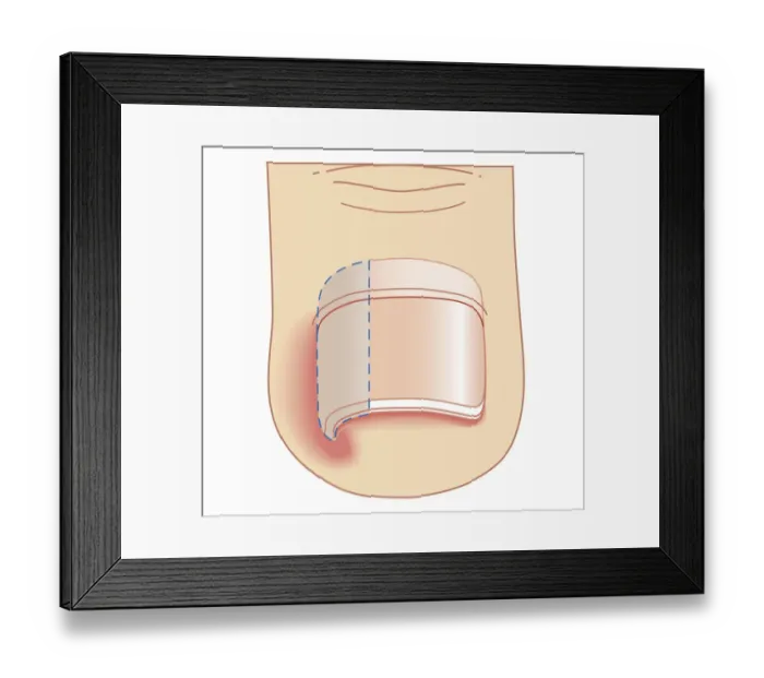 Framed Print : Cross section biomedical illustration of removal site of ingrown toenail (Onychocryptosis)