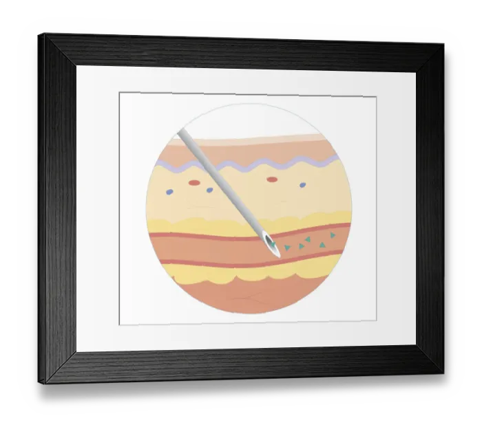 Framed Print : Cross section biomedical illustration of intravenous route of drugs injected into blood vessel for rapidly circulation