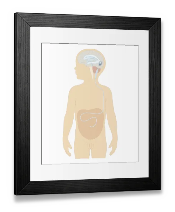 Framed Print : Cross section biomedical illustration of cerebral shunt with valve inserted in brain of boy to remove excess cerebrospinal fluid with tube to carry into stomach Framed Print : Cross section biomedical illustration of cerebral shunt with valve inserted in brain of boy to remove excess cerebrospinal fluid with tube to carry into stomach