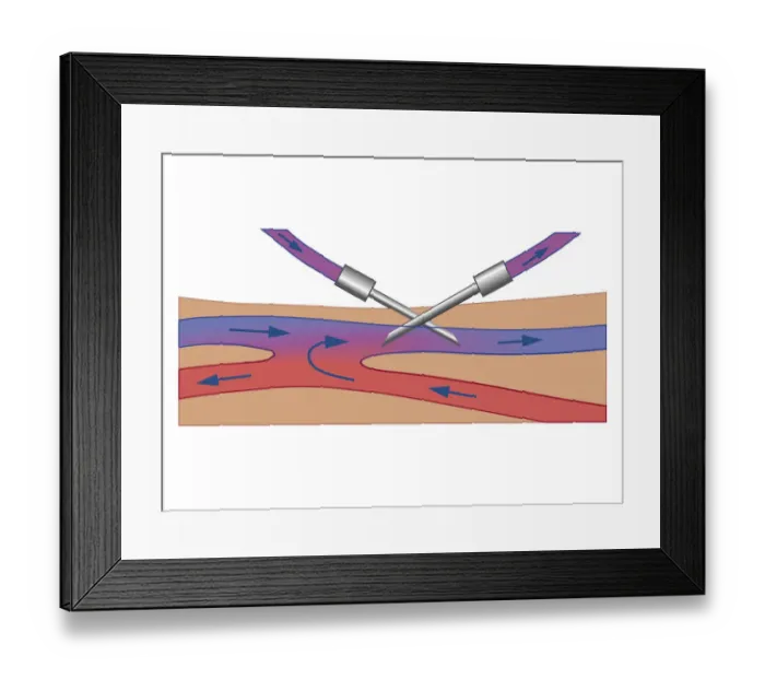 Framed Print : Cross section biomedical illustration of Haemodialysis showing needle inserted into vein and dialysate flowing in opposite direction to blood flow