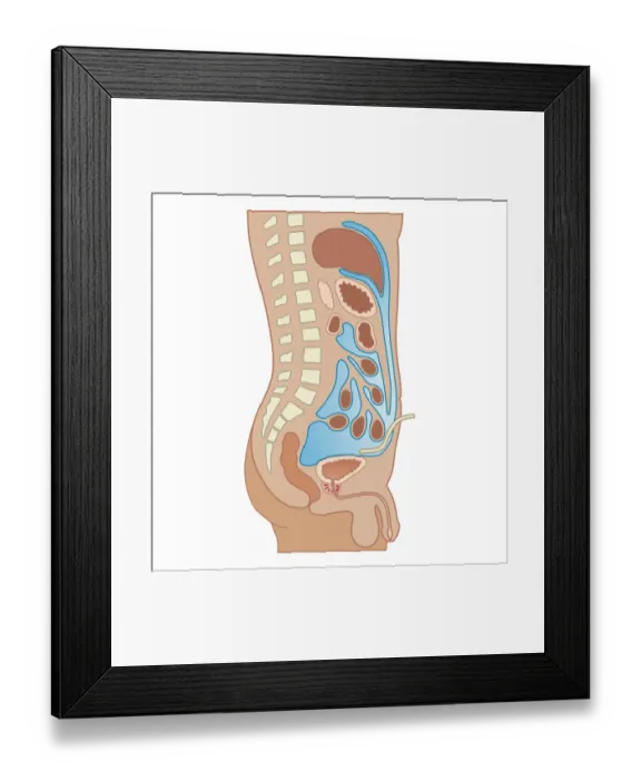 Framed Print : Cross section biomedical illustration of Peritoneal Dialysis using the peritoneum as a filter with catheter inserted through abdomen Framed Print : Cross section biomedical illustration of Peritoneal Dialysis using the peritoneum as a filter with catheter inserted through abdomen
