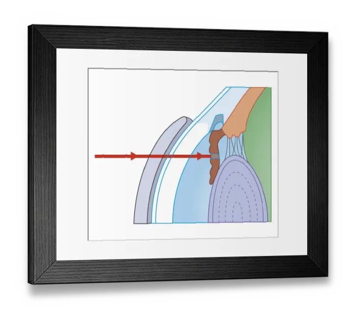 Framed Print : Cross section biomedical illustration of laser iridotomy where laser beam is focused on iris through thick contact lens to cut hole in iris