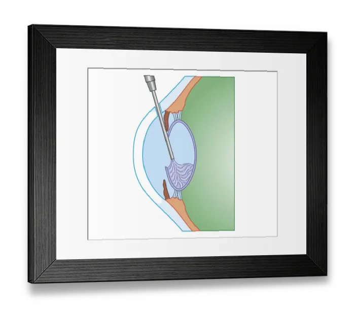 Framed Print : Cross section biomedical illustration of eye cataract surgery sucking softened tissue out using ultrasound probe inserted into lens via incision in cornea