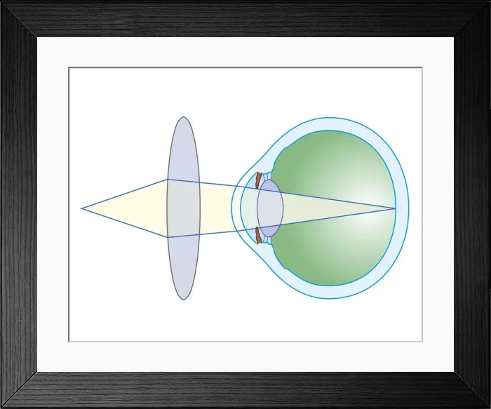 Framed Print : Cross section biomedical illustration of lens to correct hypermetropia Framed Print : Cross section biomedical illustration of lens to correct hypermetropia
