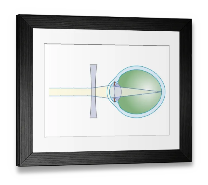 Framed Print : Cross section biomedical illustration of lens to correct myopia Framed Print : Cross section biomedical illustration of lens to correct myopia