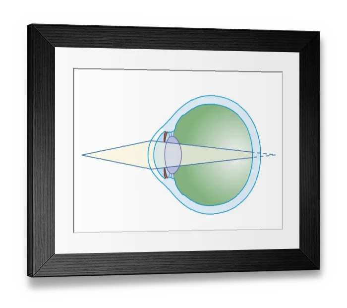 Framed Print : Cross section biomedical illustration of hypermetropia Framed Print : Cross section biomedical illustration of hypermetropia