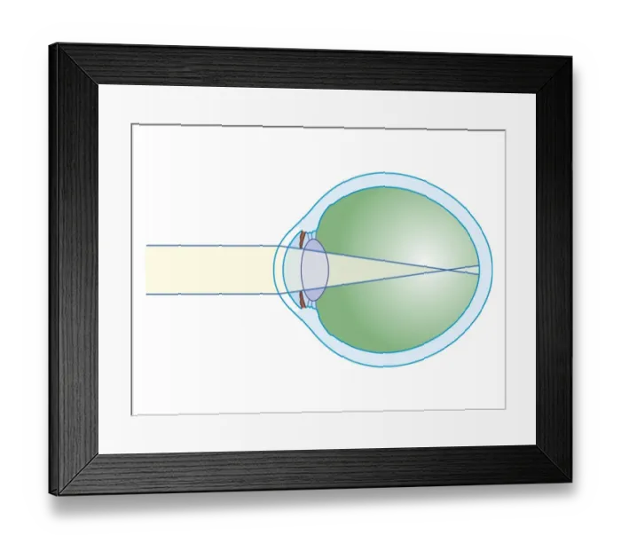 Framed Print : Cross section biomedical illustration of myopia Framed Print : Cross section biomedical illustration of myopia