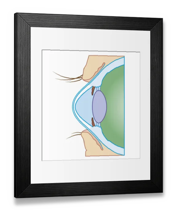 Framed Print : Cross section biomedical illustration of keratoconus or conical cornea Framed Print : Cross section biomedical illustration of keratoconus or conical cornea