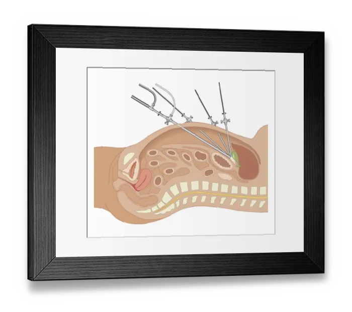 Framed Print : Cross section biomedical illustration of endoscope and tubes inserted in abdomen of adult female during Laparoscopic Surgery
