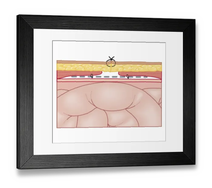 Framed Print : Cross section biomedical illustration of hernia repair using synthetic mesh Framed Print : Cross section biomedical illustration of hernia repair using synthetic mesh