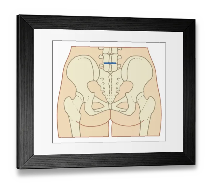 Framed Print : Cross section biomedical illustration of site of incision for microdiscectomy surgical procedure Framed Print : Cross section biomedical illustration of site of incision for microdiscectomy surgical procedure