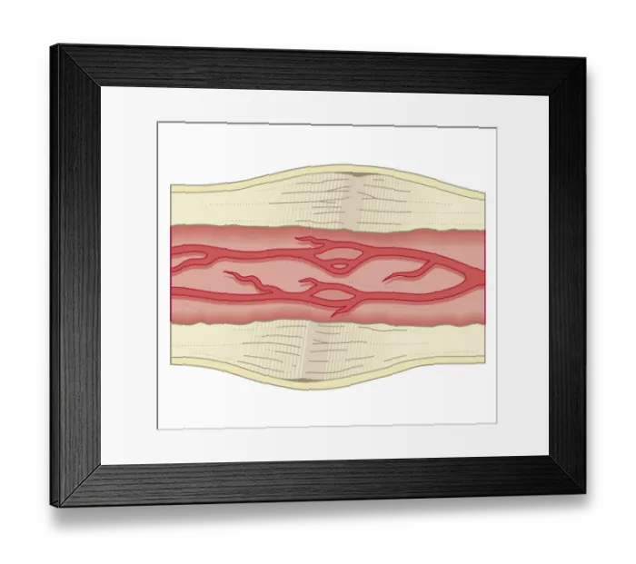 Framed Print : Cross section biomedical illustration of bone repairing itself with dense, compact bone gradually replacing the callus, and blood vessel regrowth