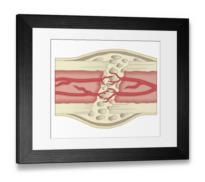 Framed Print : Cross section biomedical illustration of bone repairing itself with new, soft, spongy callus developing on framework provided by fibrous tissue, joining the broken ends Framed Print : Cross section biomedical illustration of bone repairing itself with new, soft, spongy callus developing on framework provided by fibrous tissue, joining the broken ends