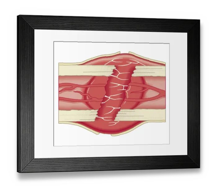 Framed Print : Cross section biomedical illustration of bone repairing itself with clot forming to seal broken blood vessels and fibrous tissue forming to replace the clot Framed Print : Cross section biomedical illustration of bone repairing itself with clot forming to seal broken blood vessels and fibrous tissue forming to replace the clot