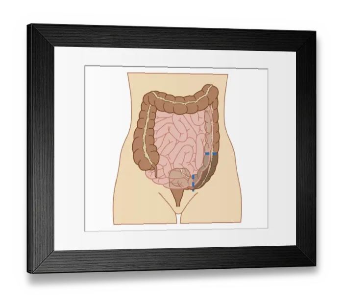 Framed Print : Cross section biomedical illustration of partial colectomy Framed Print : Cross section biomedical illustration of partial colectomy