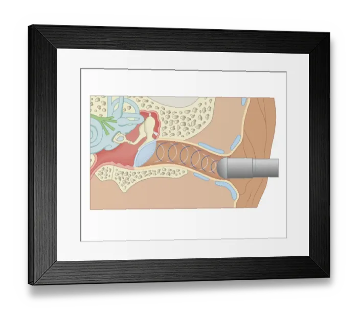 Framed Print : Cross section biomedical illustration of tympanometer probe inserted in ear to test middle ear and eardrum (Tympanometry) Framed Print : Cross section biomedical illustration of tympanometer probe inserted in ear to test middle ear and eardrum (Tympanometry)