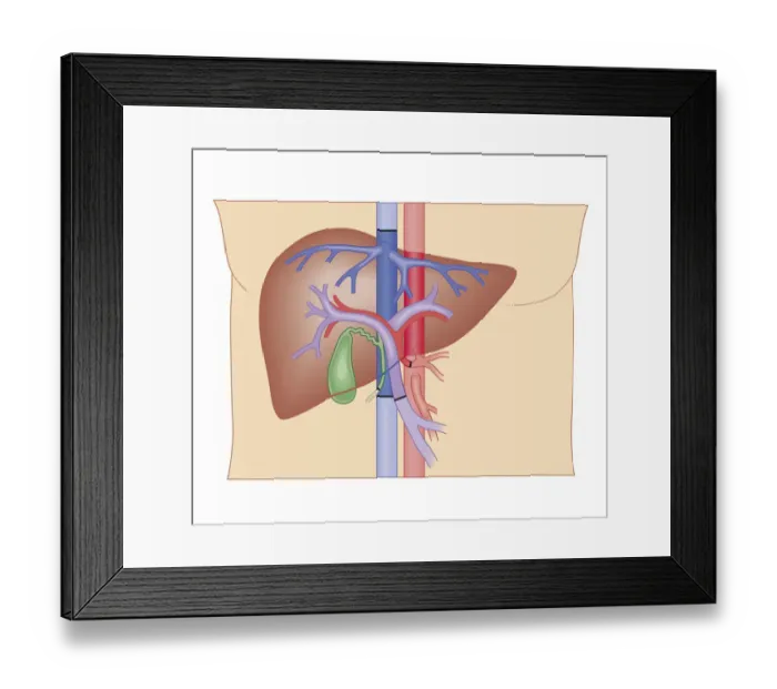 Framed Print : Cross section biomedical illustration of liver transplant procedure Framed Print : Cross section biomedical illustration of liver transplant procedure