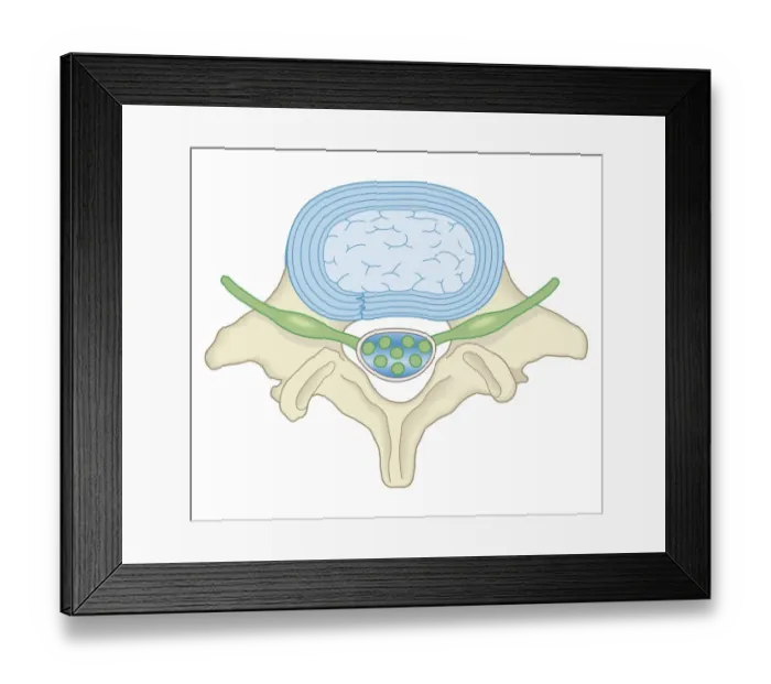 Framed Print : Cross section biomedical illustration of lumber microdisectomy after surgery Framed Print : Cross section biomedical illustration of lumber microdisectomy after surgery