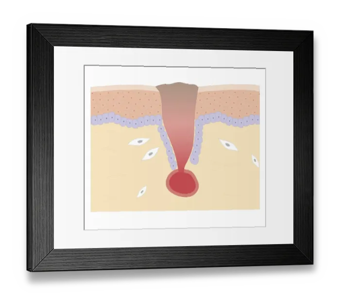Framed Print : Cross section biomedical illustration of blood clotting over broken skin and fibroblasts multiplying and migrating to injury Framed Print : Cross section biomedical illustration of blood clotting over broken skin and fibroblasts multiplying and migrating to injury