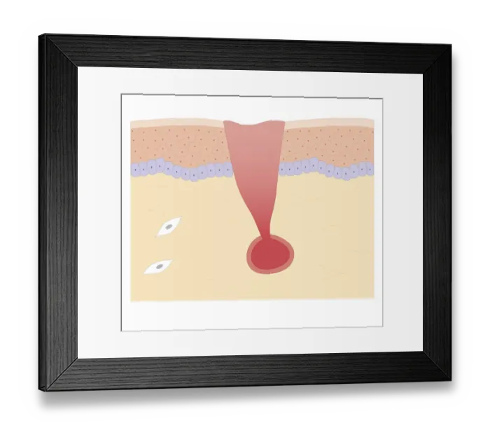 Framed Print : Cross section biomedical illustration of damaged skin and blood vessel Framed Print : Cross section biomedical illustration of damaged skin and blood vessel