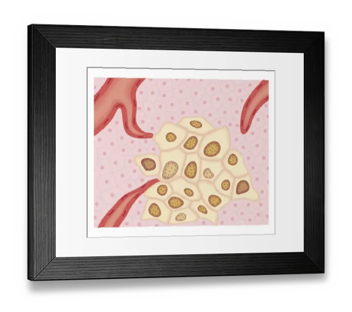 Framed Print : Cross section biomedical illustration of Angiogenesis - how tumour obtains nutrients Framed Print : Cross section biomedical illustration of Angiogenesis - how tumour obtains nutrients
