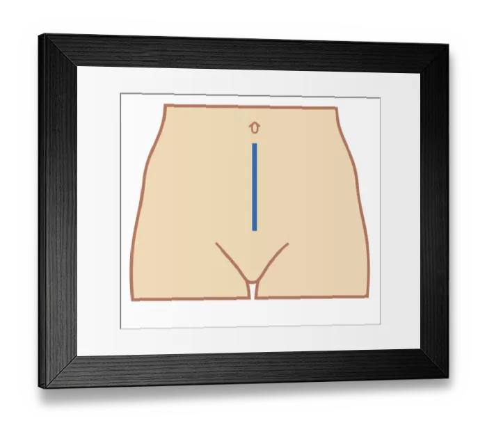 Framed Print : Cross section biomedical illustration of position of colectomy incision