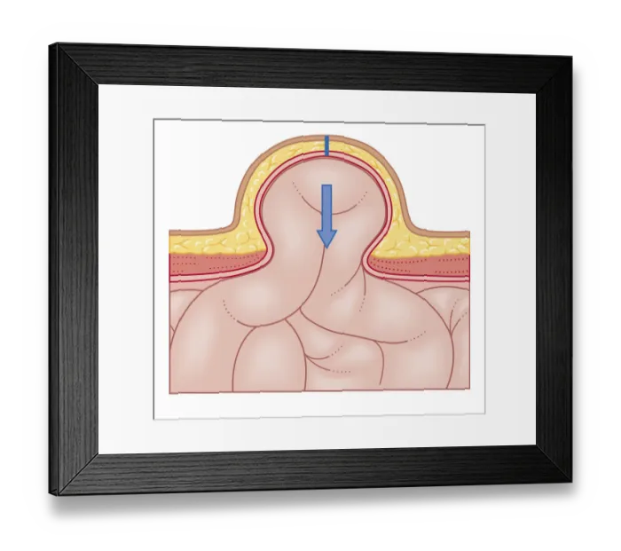 Framed Print : Cross section biomedical illustration of hernia repair and site of incision to uncover the hernia Framed Print : Cross section biomedical illustration of hernia repair and site of incision to uncover the hernia