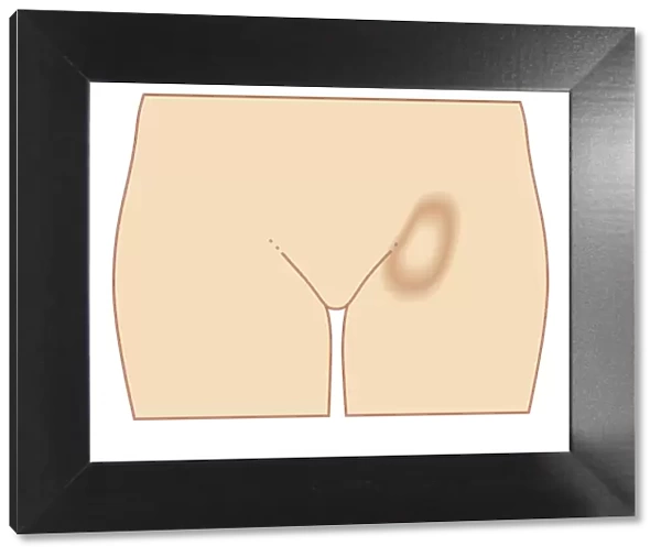 Biomedical illustration of femoral hernia in female