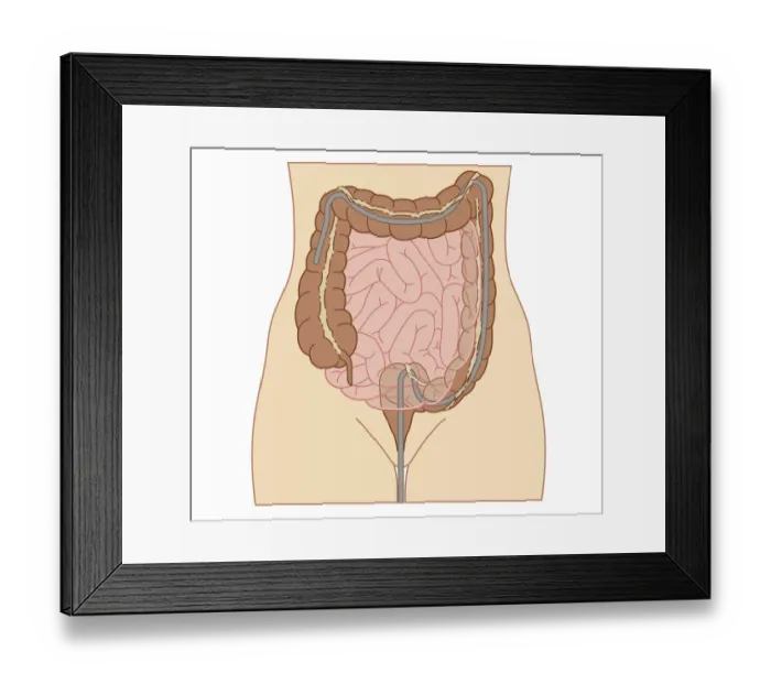 Framed Print : Cross section biomedical illustration of colonoscopy procedure in adult female Framed Print : Cross section biomedical illustration of colonoscopy procedure in adult female