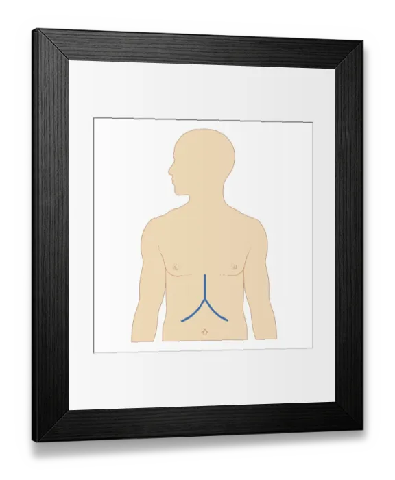 Framed Print : Biomedical illustration of incision site for liver transplant Framed Print : Biomedical illustration of incision site for liver transplant