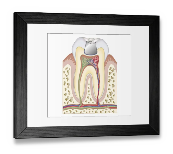 Framed Print : Cross section biomedical illustrationBiomedical illustration of dental filling Framed Print : Cross section biomedical illustrationBiomedical illustration of dental filling