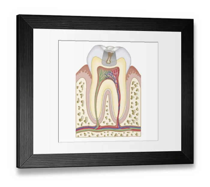 Framed Print : Cross section biomedical illustration of tooth decay before dental filling Framed Print : Cross section biomedical illustration of tooth decay before dental filling
